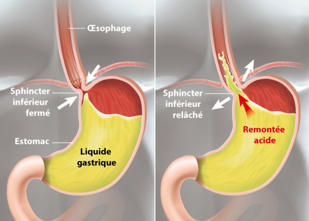 reflux-gastro-oesophagien-h-pital-priv-d-antony